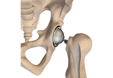 Total Hip Replacement Surgery