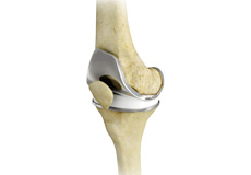 Total Knee Replacement Surgery